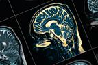 COVID-19 może zwiększać ryzyko chorób neurodegenercyjnych [BADANIE]