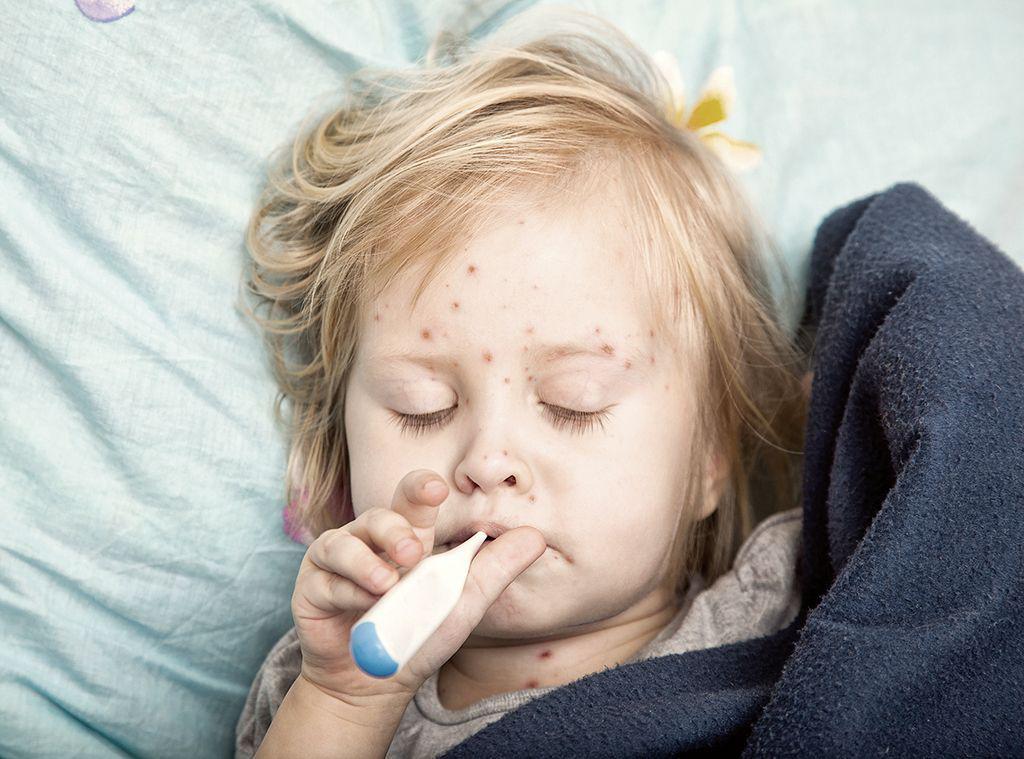 Kiedy Do Przedszkola Po Ospie Wietrznej Węgry: od jesieni obowiązkowe szczepienie przeciw ospie wietrznej