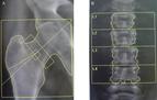 Densytometria kostna: jak właściwie interpretować badania densytometryczne kręgosłupa?