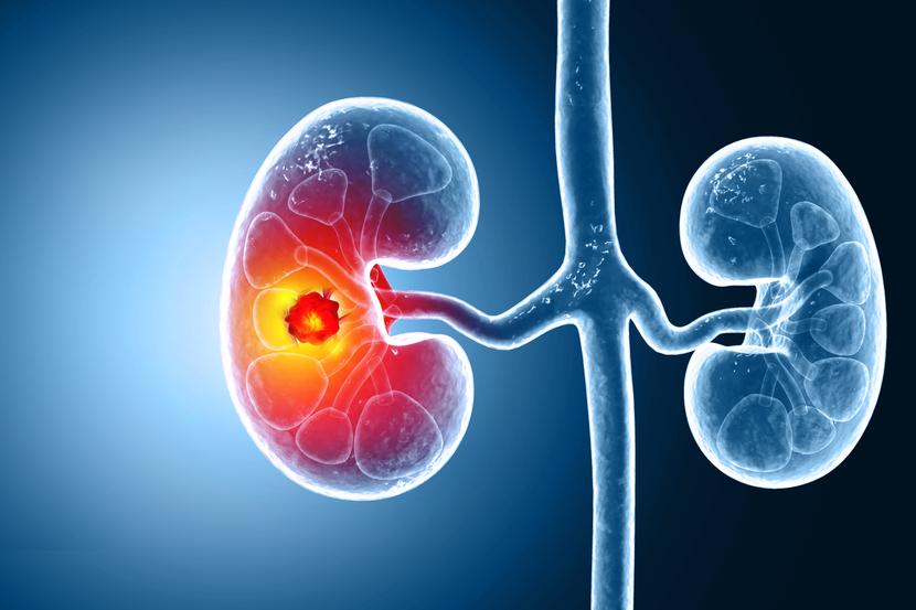 Połączenie kabozantynibu z niwolumabem wykazuje zarówno korzyści długoterminowe, jakie wynikają z leczenia immunologicznego, jak i te, pozwalające na uzyskanie szybkiej odpowiedzi, co zapewnia kabozantynib - podkreśla ekspert. Połączenie kabozantynibu z niwolumabem wykazuje zarówno korzyści długoterminowe, jakie wynikają z leczenia immunologicznego, jak i te, pozwalające na uzyskanie szybkiej odpowiedzi, co zapewnia kabozantynib - podkreśla ekspert.
