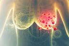 W guzach nowotworowych odkryto grzyby. “Nowy znak rozpoznawczy raka”?