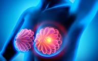 Leczenie raka piersi z przerzutami do węzłów chłonnych: rola testów genetycznych w ocenie korzyści z chemioterapii