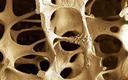 Światowy Dzień Chorych na Osteoporozę