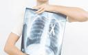 Immunoterapia zmieniła paradygmat terapii nowotworów płuca