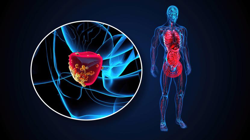 Biopsja fuzyjna prostaty ma być refundowana. Biopsja fuzyjna prostaty ma być refundowana.